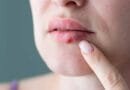 Herpes labial