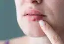 Herpes labial