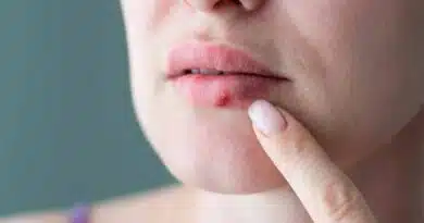 Herpes labial, infección viral que tiende a reaparecer Herpes labial