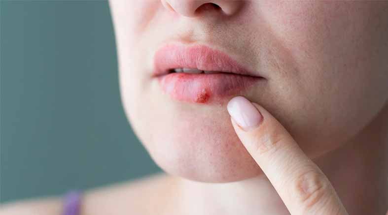 Herpes labial
