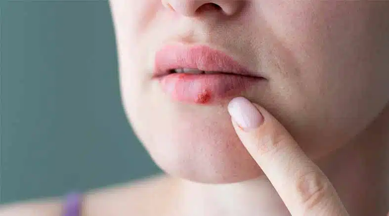 Herpes labial, infección viral que tiende a reaparecer 1 Herpes labial
