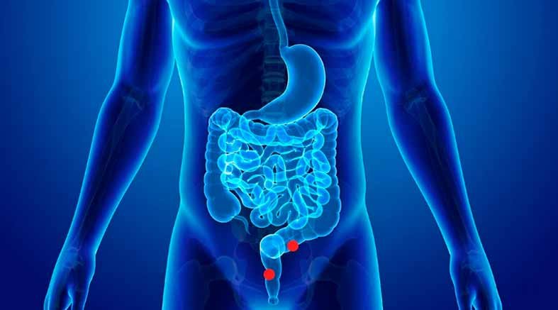Cáncer de colon, curable si se detecta a tiempo 1 curable