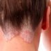 Psoriasis
