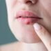 Herpes labial
